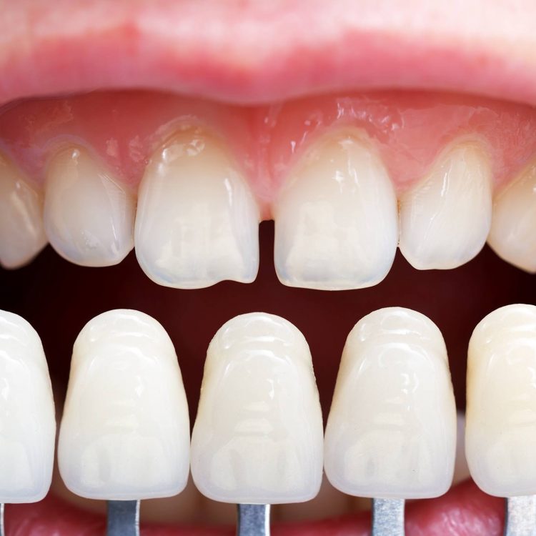 veneers